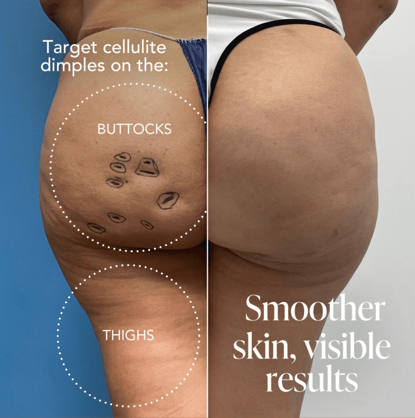 Aveli cellulite treatment at LovMedSpa