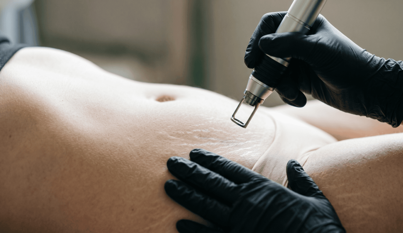 CO2 Stretch Mark Reduction — Body Skin at LovMedSpa