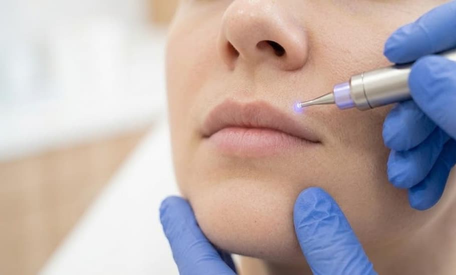 Laser Hair Removal — Small — Laser Hair Removal at LovMedSpa
