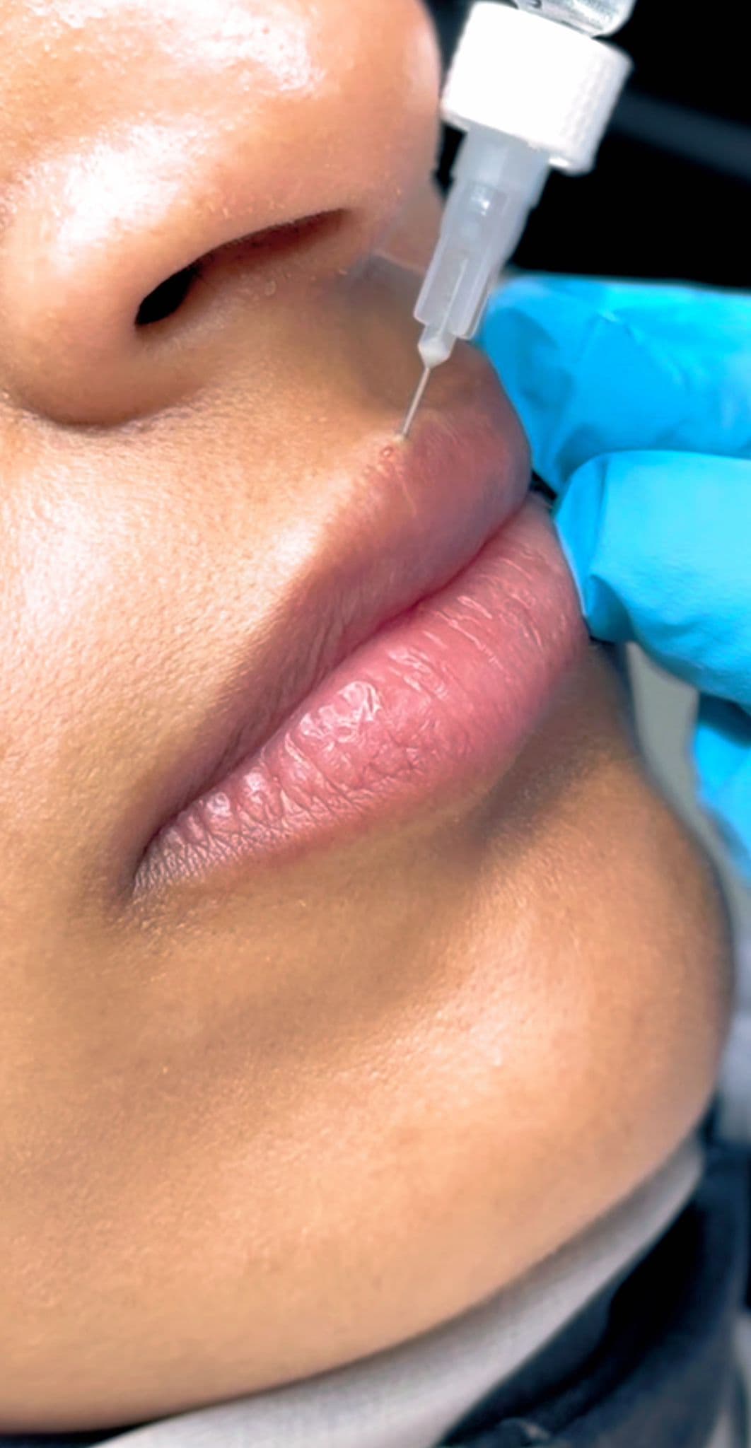 Lip Filler — Lip Enhancement at LovMedSpa