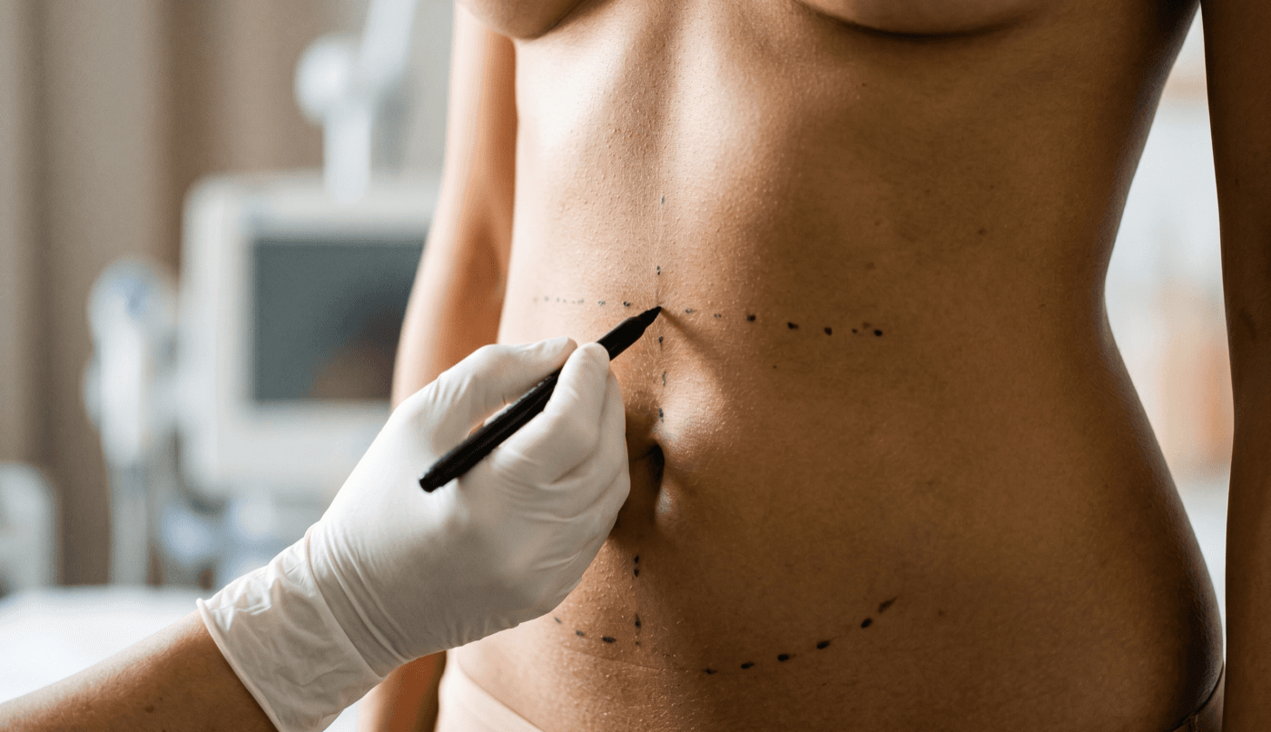 Liquid Lipo — Body — PCDC Fat Dissolving at LovMedSpa