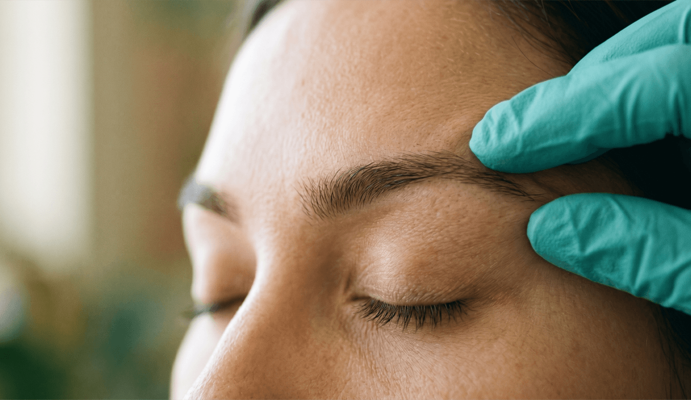 Fox Eye Lift — Thread Lifts at LovMedSpa