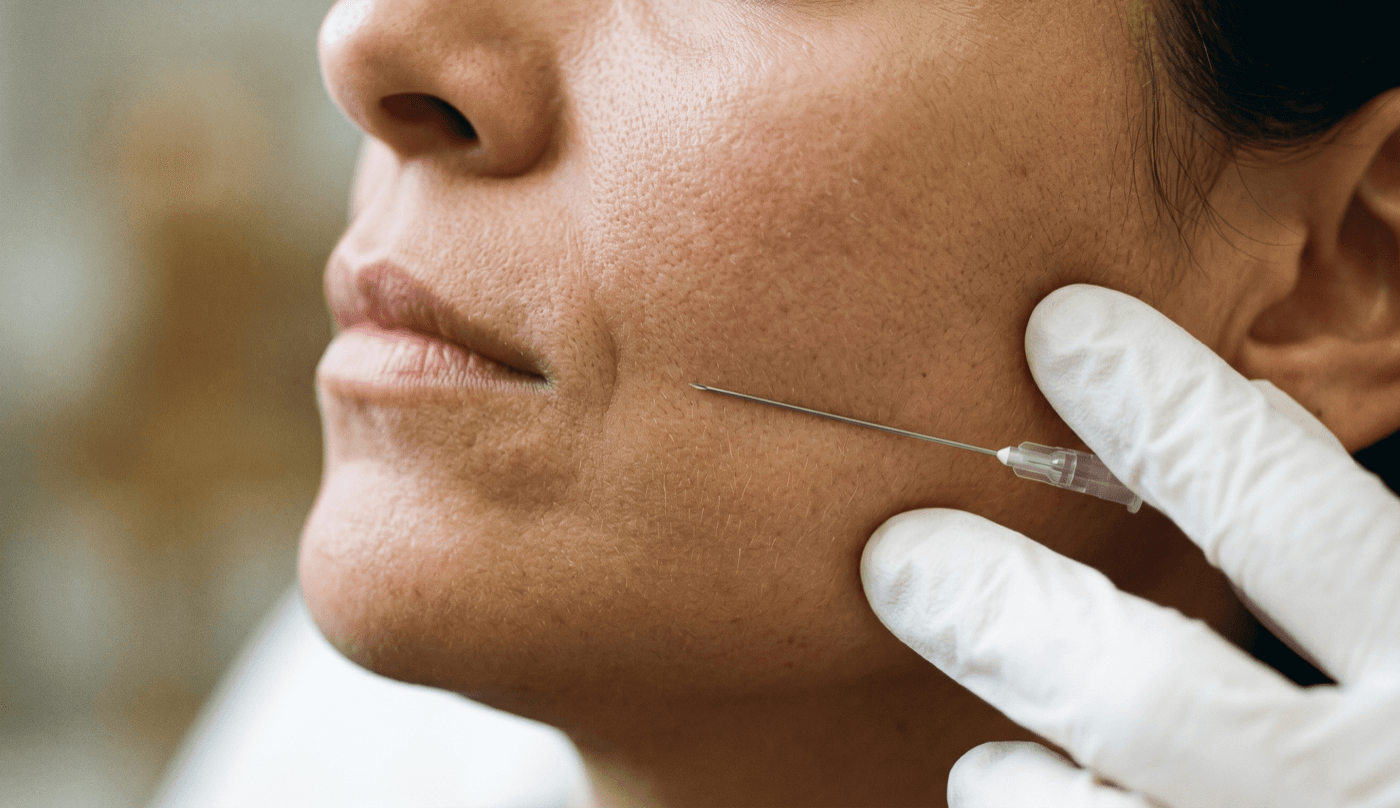 PDO Smooth Threads — Face — Skin Tightening at LovMedSpa