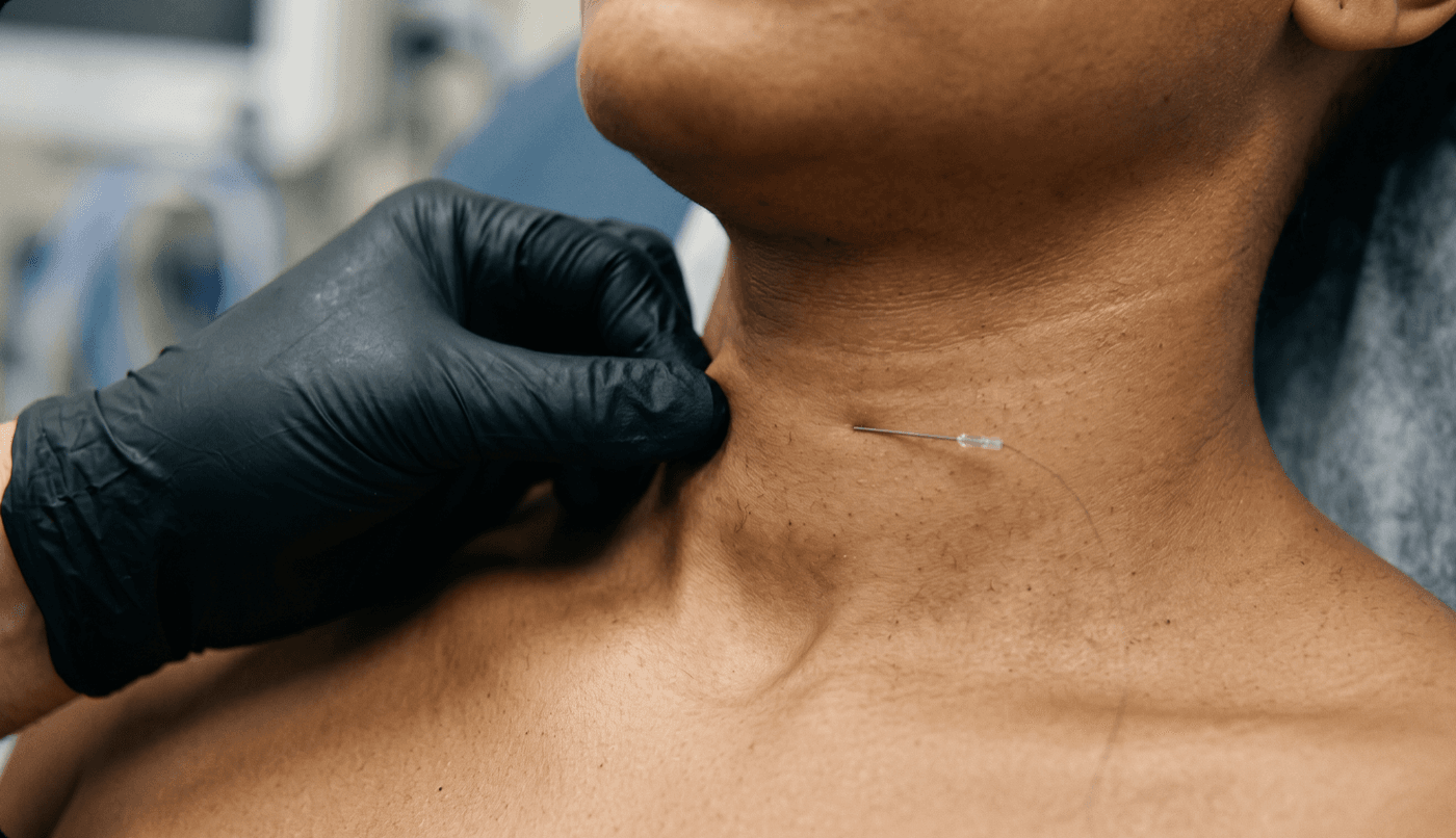 PDO Smooth Threads — Neck — Skin Tightening at LovMedSpa