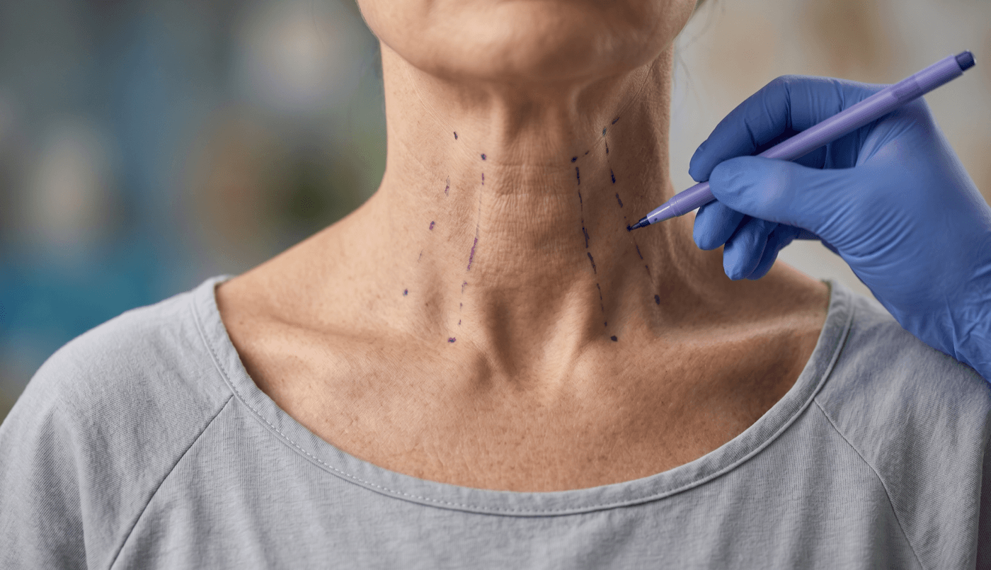 Platysmal Bands — Neck Rejuvenation at LovMedSpa