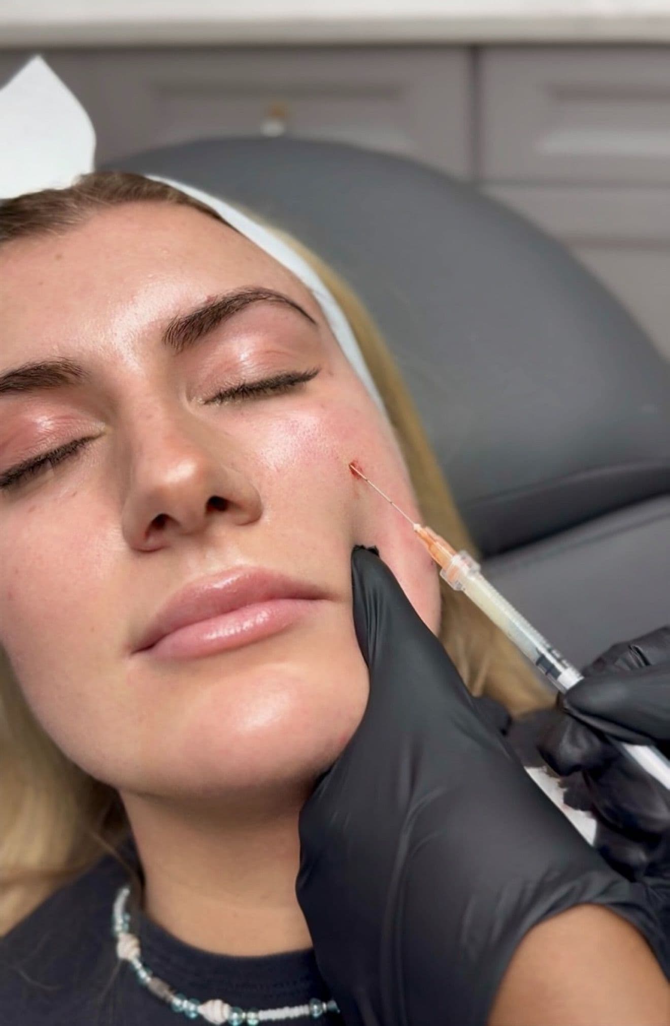 Under-Eye Renewal — Regenerative Therapy at LovMedSpa
