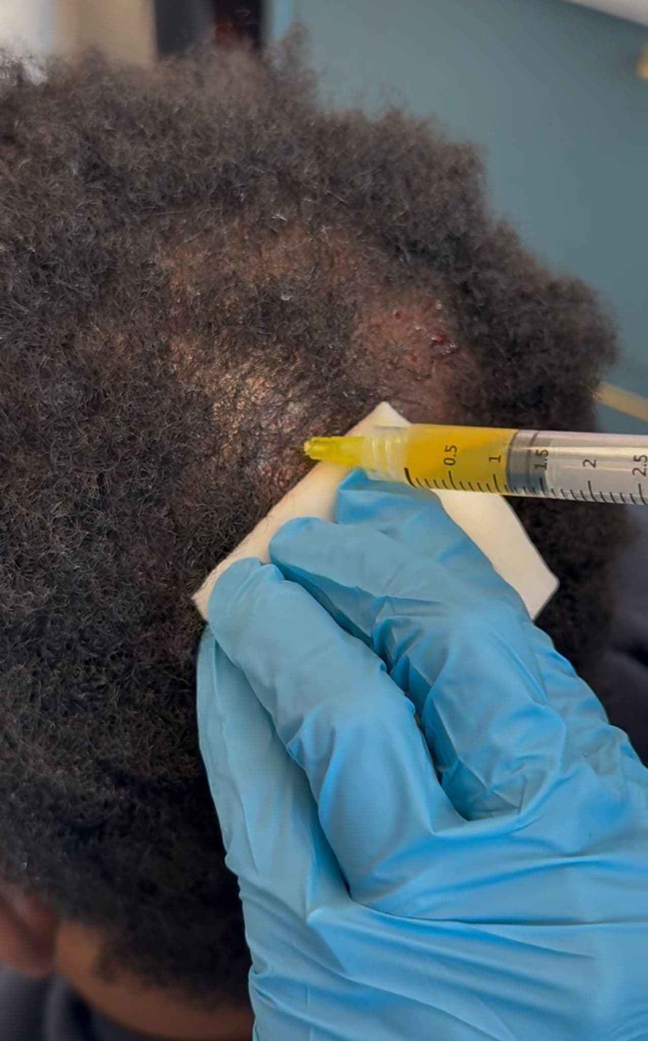 PRP Hair Revival — Hair Restoration at LovMedSpa