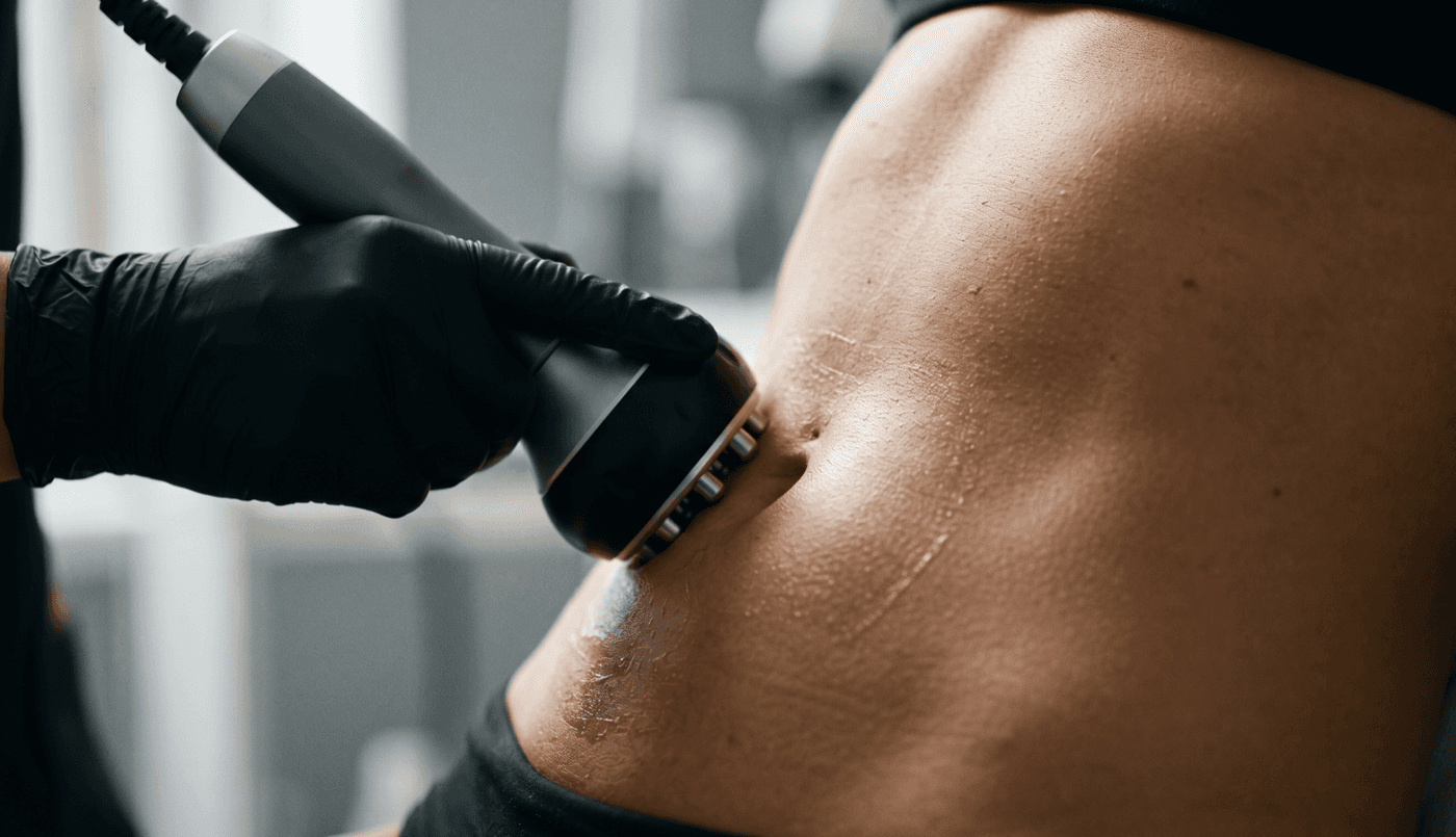 Quantum RF Body Sculpting — Non-Invasive RF at LovMedSpa
