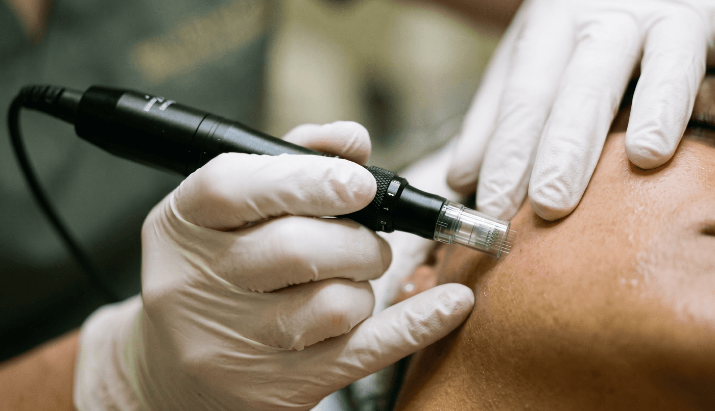 RF Microneedling — Collagen Induction at LovMedSpa