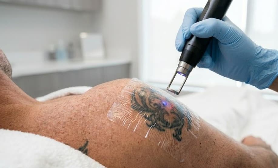 Tattoo Removal — Medium — Laser Tattoo Removal at LovMedSpa