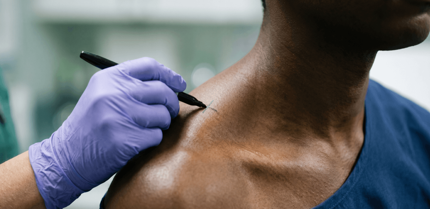 Trapezius Treatment — Shoulder Slimming at LovMedSpa